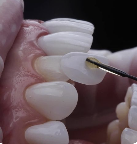 Implante dental
