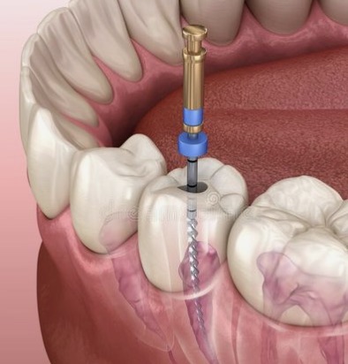Tratamiento de conducto en un molar inferior