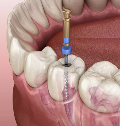 Implante dental