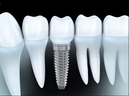 Implante dental entre piezas naturales, visto en corte