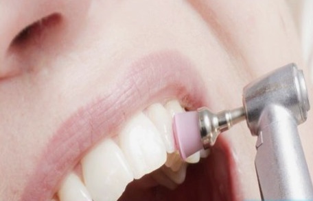 Profilaxis dental con copa de goma