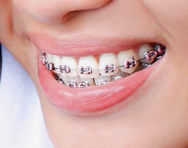 Dentadura con brackets metálicos de ortodoncia
