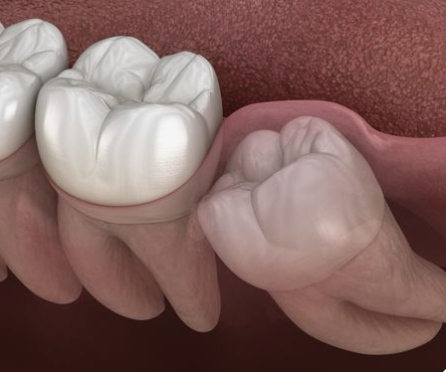 Implante dental